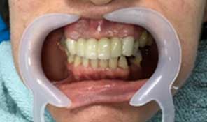 Estética Dental Protesis Sin Metal