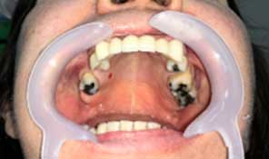 Estética Dental Prótesis Sin Metal