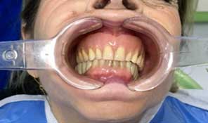 Implante Dental Guiada Sin Dolor