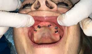 Implante Dental Guiada Sin Dolor