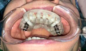 Odontología Digital Planeación De Implantes